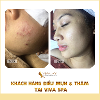 Ảnh khách hàng trị mụn 9